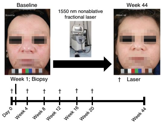 《自然》子刊:破解激光祛疤祛皱之谜!霍普金斯大学科学家发现,激光能激活一条重要毛囊再生通路,促进皮肤重获新生丨科学大发现