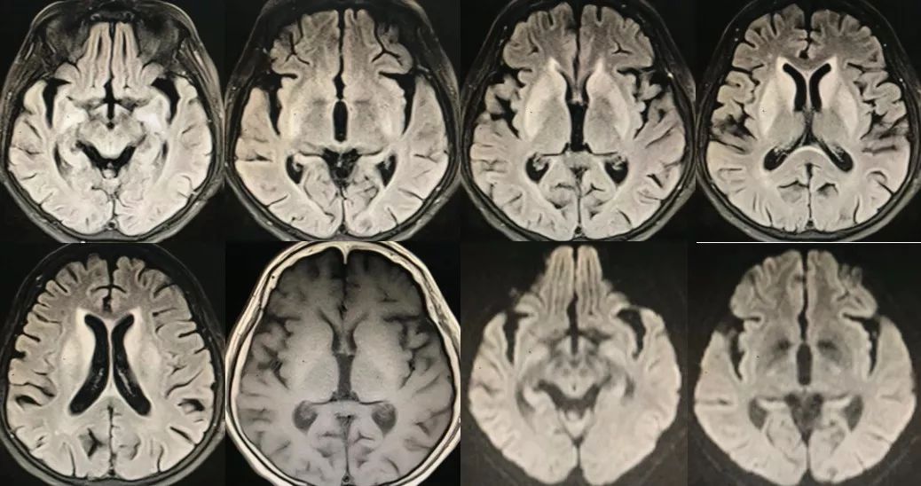 急性脂肪栓塞、神经白塞病、NMOSD极后区综合征丨3分钟读片·第11期