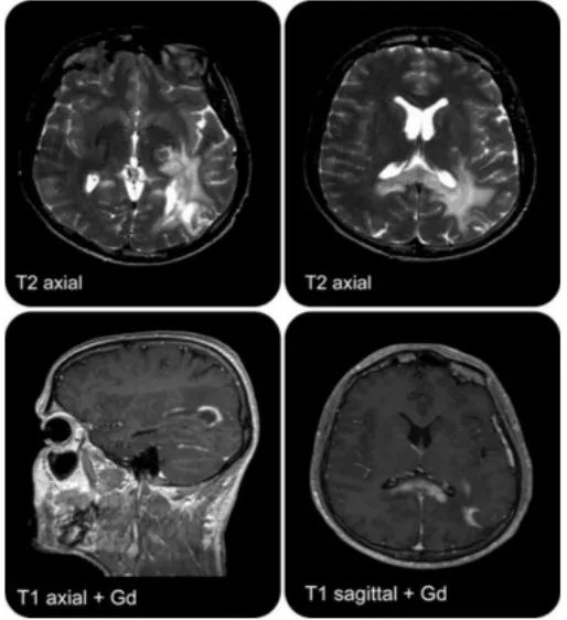急性脂肪栓塞、神经白塞病、NMOSD极后区综合征丨3分钟读片·第11期