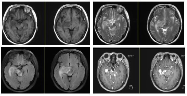 急性脂肪栓塞、神经白塞病、NMOSD极后区综合征丨3分钟读片·第11期