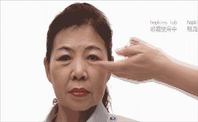 眼袋松弛下垂最快解决方法,严重眼袋下垂松弛怎么恢复