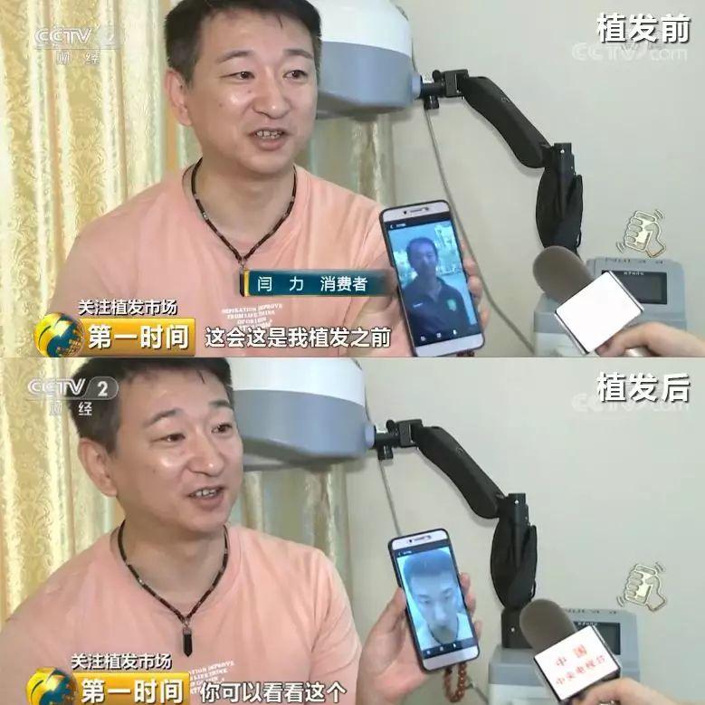 头顶脱发植发有用吗,中国脱发人数2024