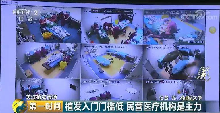 头顶脱发植发有用吗,中国脱发人数2024