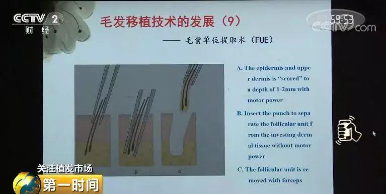 头顶脱发植发有用吗,中国脱发人数2024