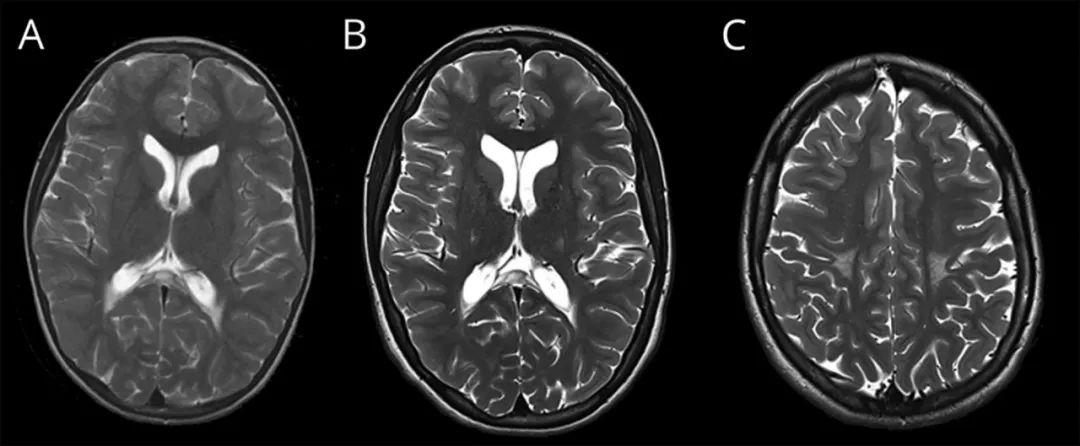 高足弓+周围神经病,还要考虑这个病丨临床推理