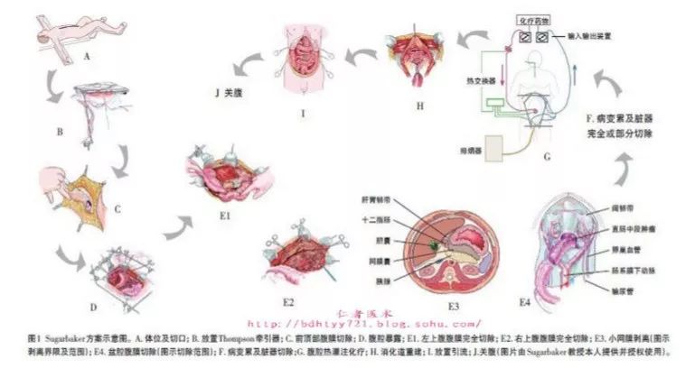 崔书中精准腹腔热灌注化疗技术,许洪斌医生的科普号