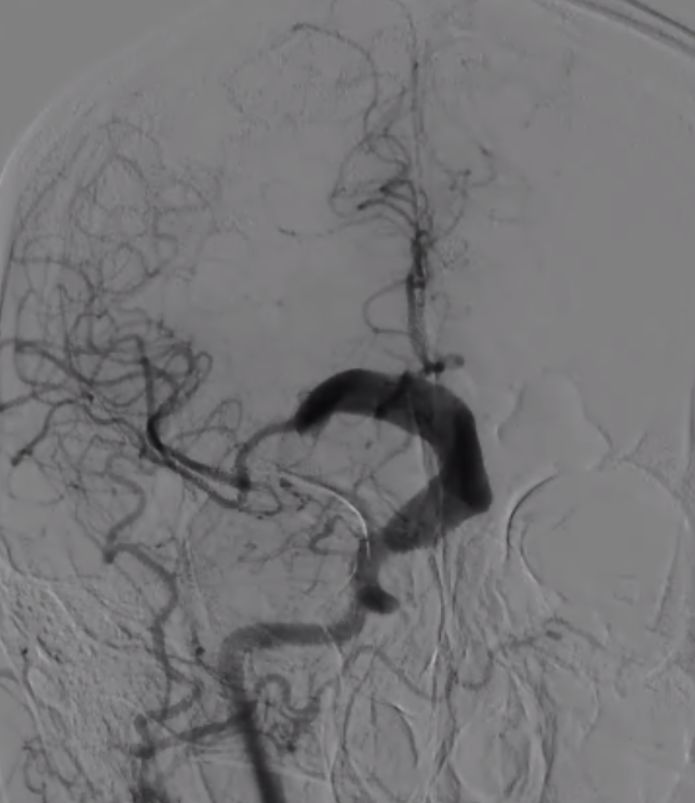 物华天宝·第7期｜脑部长型巨大夹层动脉瘤的4个密网支架桥接治疗复查治愈（附复查CTA结果）
