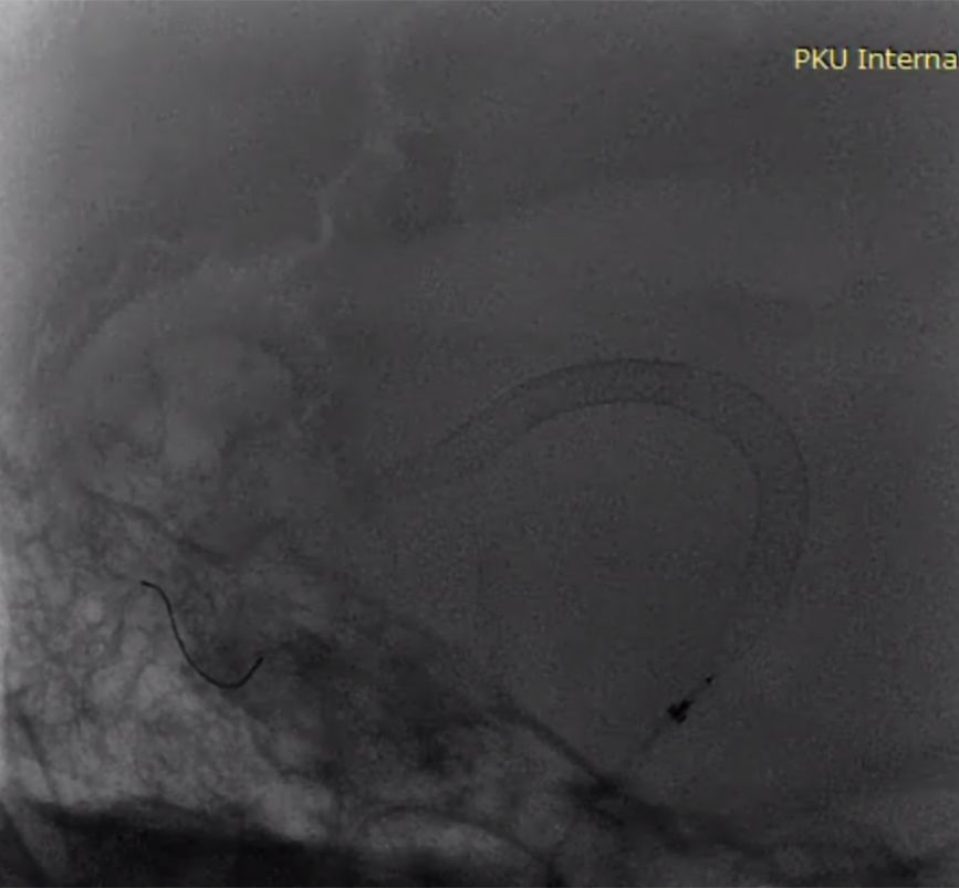 物华天宝·第7期｜脑部长型巨大夹层动脉瘤的4个密网支架桥接治疗复查治愈（附复查CTA结果）