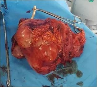 膀胱低级别肌纤维母细胞增生,膀胱纤维母细胞瘤