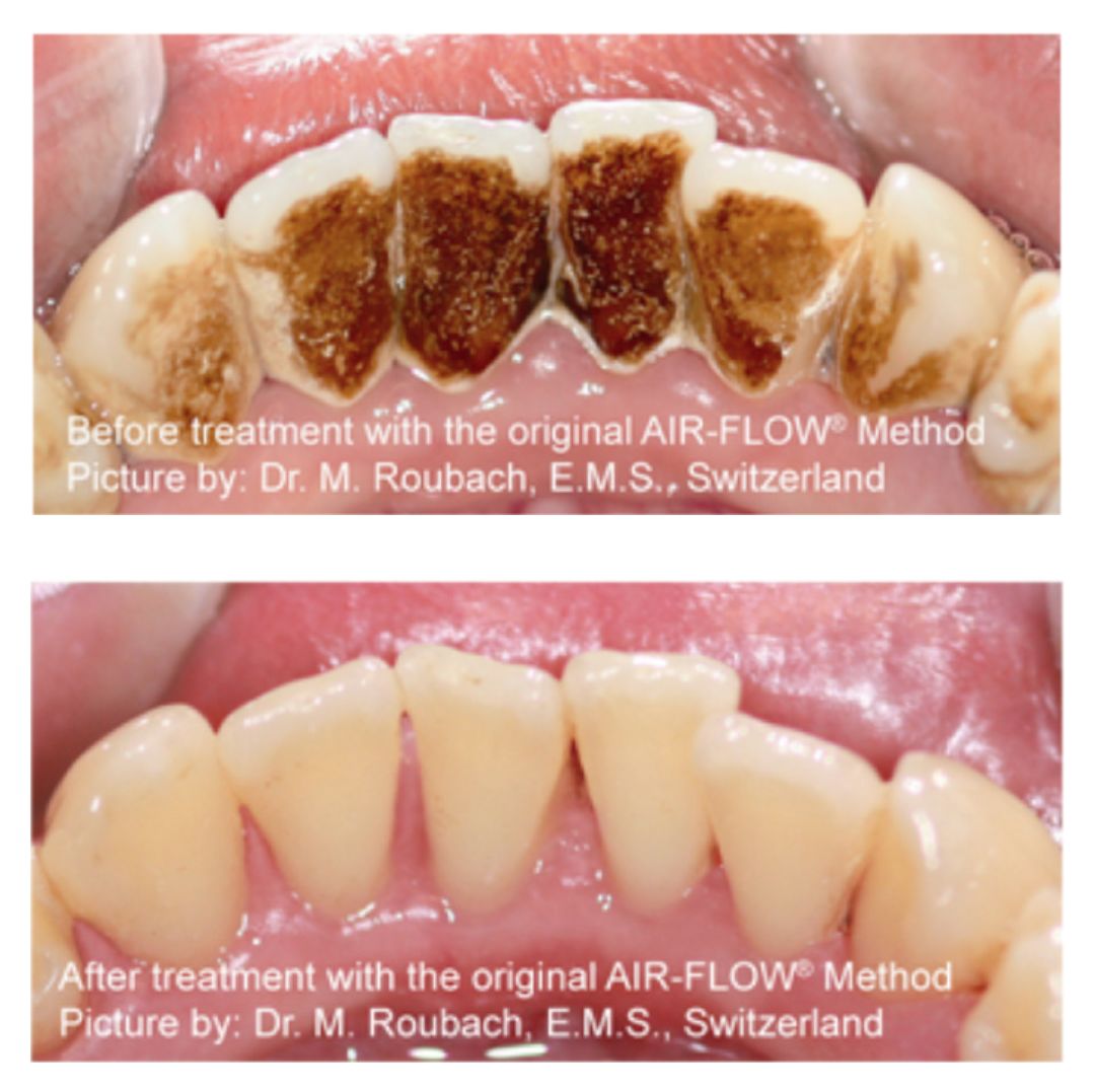 为什么下门牙突,特别爱长牙石是怎么回事
