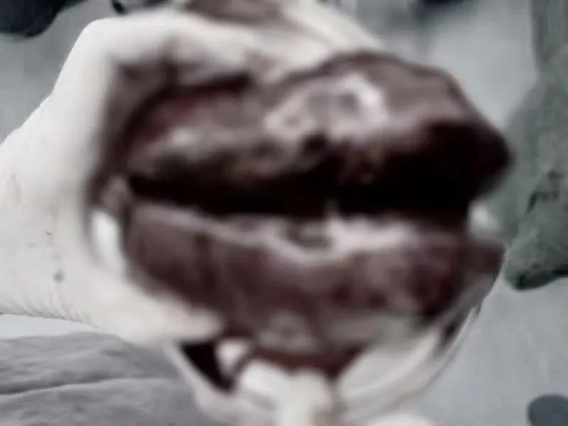 42岁大妈肚子突出如5月身孕，巨大瘤子在子宫内扭转