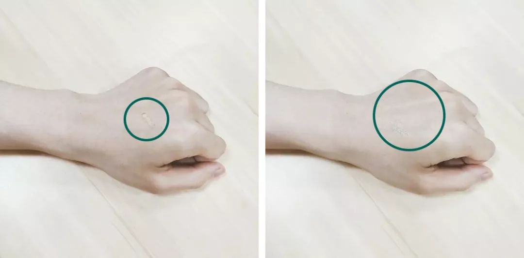 专治痘印痘坑方法,痘印的克星激光