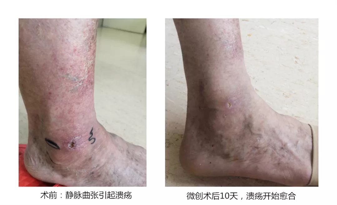 静脉曲张怎么保护好腿,夏季静脉曲张护腿