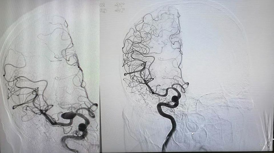 治疗颅内动脉瘤新型密网支架,密网支架处理动脉瘤的风险