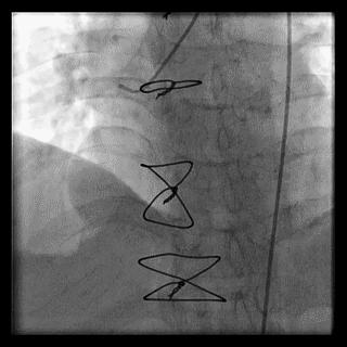 冠脉造影技术成熟不,跟我学技术分析从入门到精通