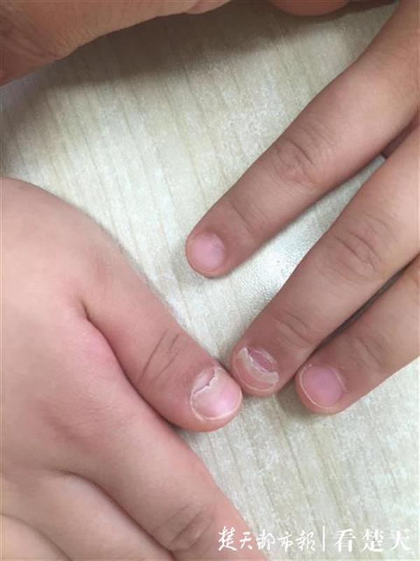 三岁孩子指甲脱落是灰指甲吗,5岁男童指甲盖分层