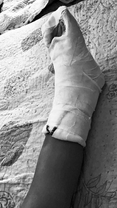 孩子跳蹦蹦床腿崴了一下,小孩跳蹦蹦床闪了腿有事吗