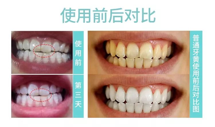 团购|俄罗斯亮白牙膏组合，轻松瓦解多年牙垢，清新口气告别黄牙