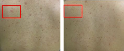 背上长痘痘的原因和解决方法,背上长痘痘的原因和解决方法医生