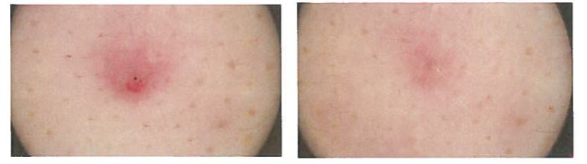 背上长痘痘的原因和解决方法,背上长痘痘的原因和解决方法医生