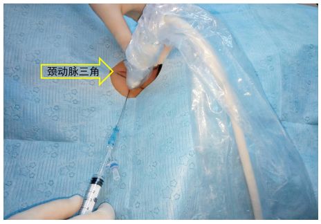 围术期中心静脉监测的专家共识（2017版）