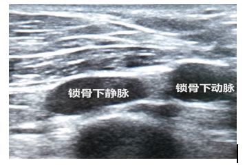 围术期中心静脉监测的专家共识（2017版）