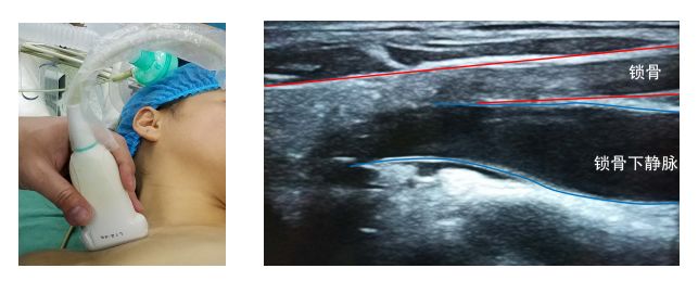 围术期中心静脉监测的专家共识（2017版）