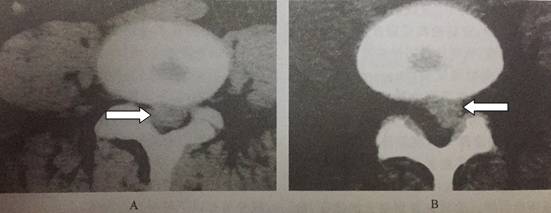 腰椎间盘突出各种疗法,腰椎间盘突出压迫神经的中医疗法