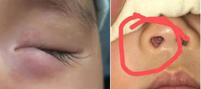 小儿童眼肿瘤,孩子斗鸡眼眼球震颤