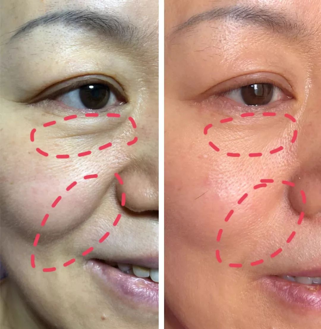法令纹眼纹一个都逃不掉,法令纹和眼纹怎么才能有效改善