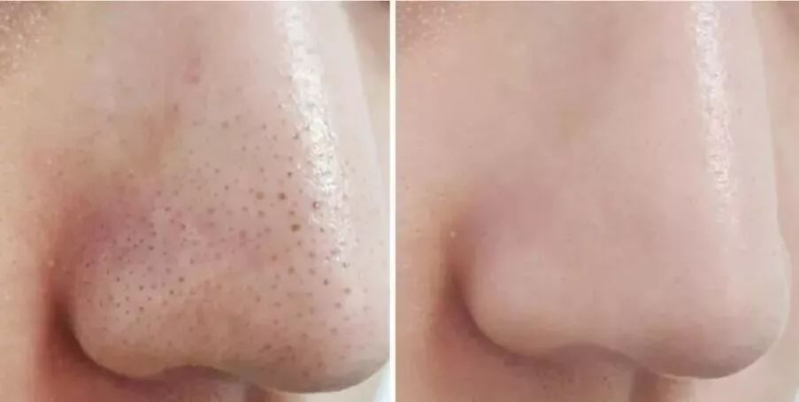 草莓鼻去黑头好物推荐使用,草莓鼻去黑头导出液