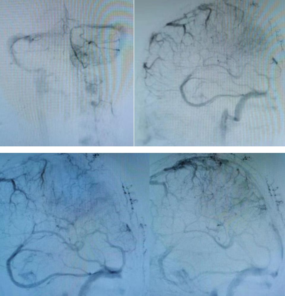 矛盾反应、Carney综合征、脑梗死、笑气中毒丨3分钟读片·第19期