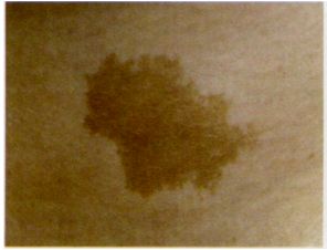 祛斑首选护肤品,祛斑最好的克星