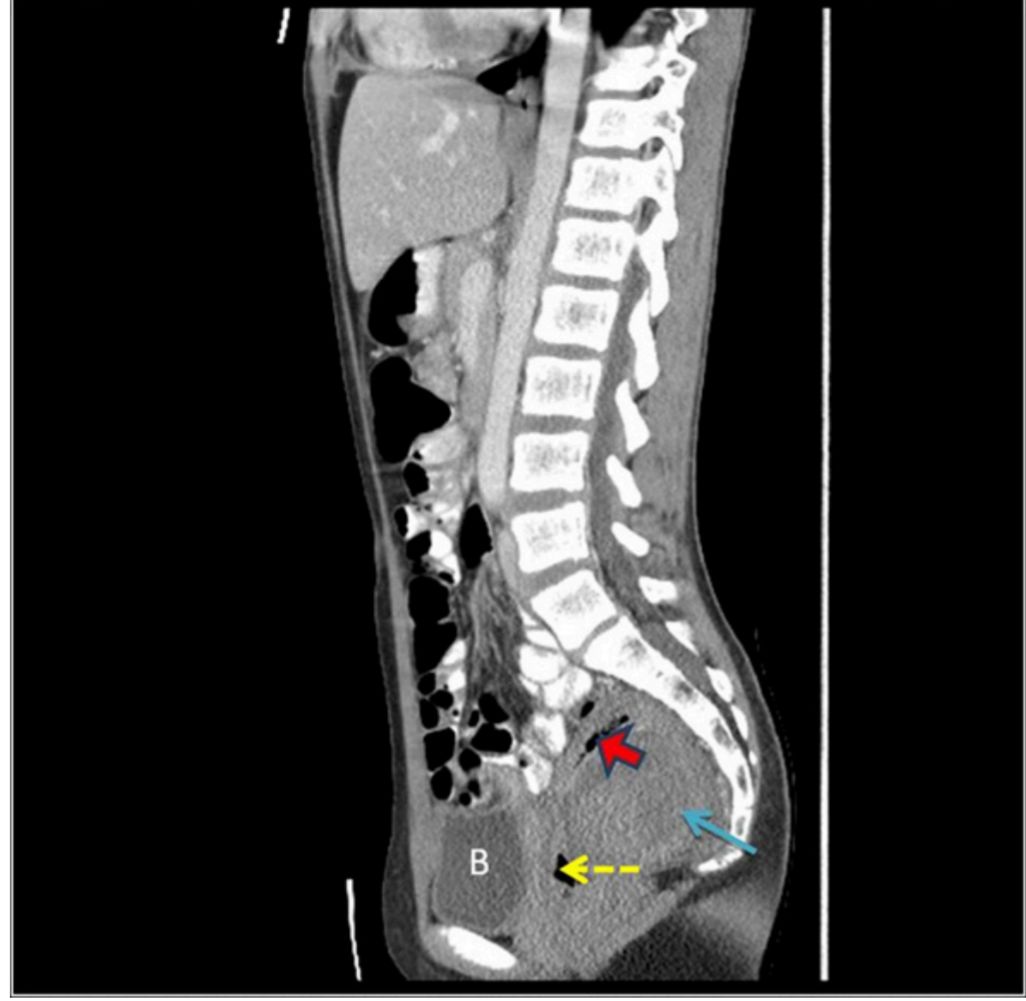 肠重复畸形严重吗,宝宝肠重复畸形怎么治疗
