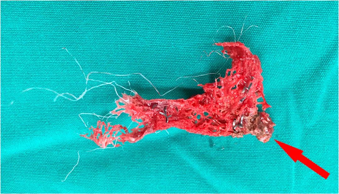 膀胱结石有误诊情况吗,膀胱结石的真实案例