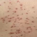 战痘总结,战痘十年是什么样子