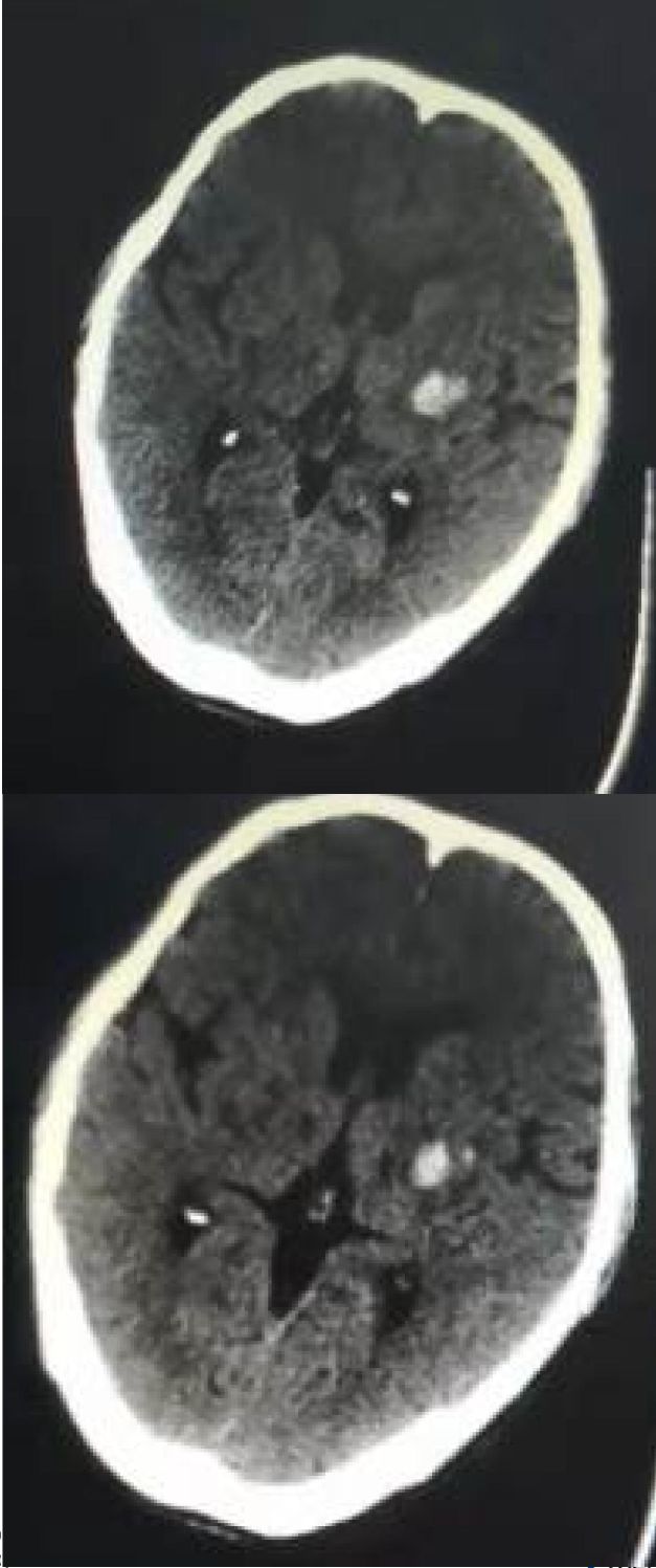 高氨血症有哪些表现,高氨血症