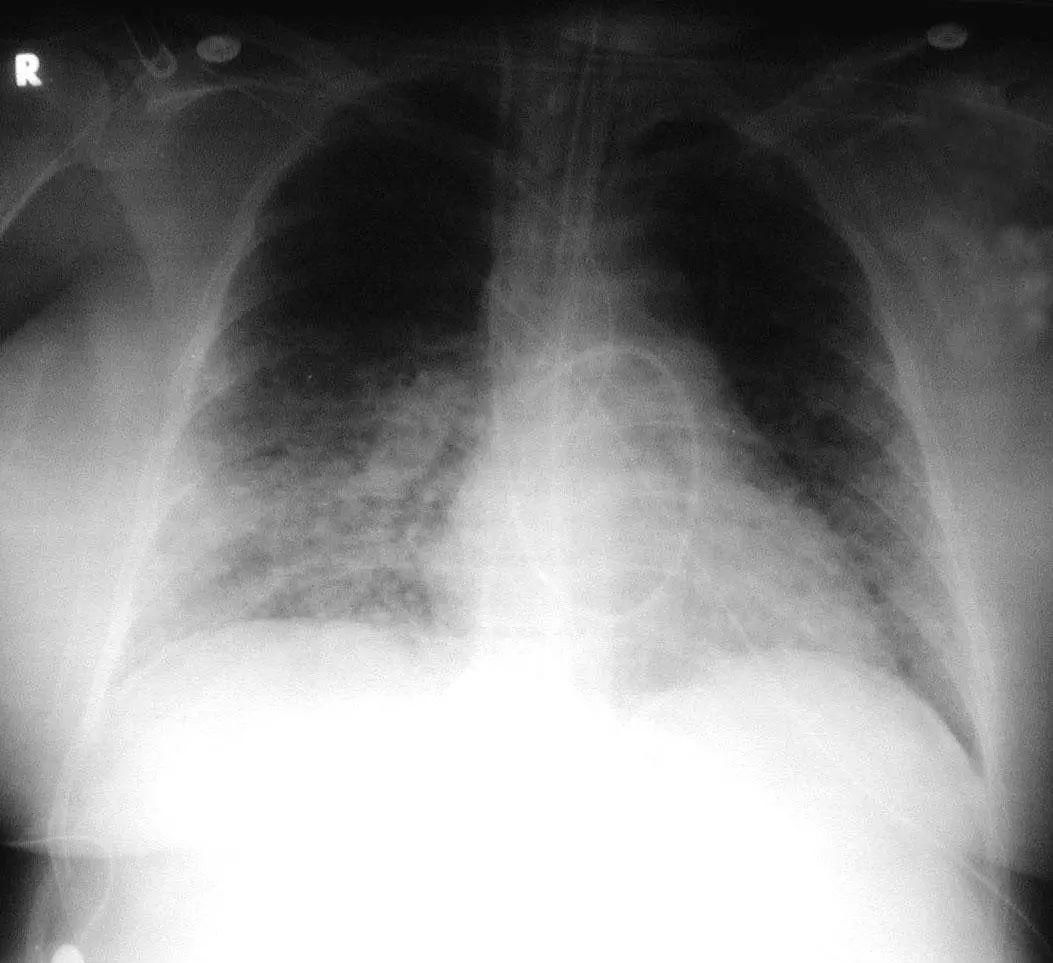 26张图，搞懂细菌性肺炎与病毒性肺炎