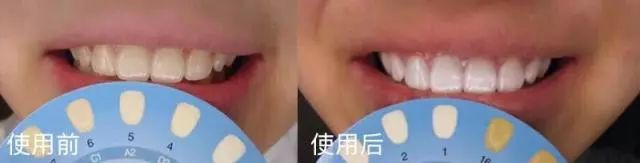 不用打磨牙齿的快速美白方法,不用洗牙能把牙垢黄牙变白的方法
