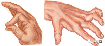 指尖发麻有针刺感看什么科室,左手拇指食指发麻针灸怎么治疗