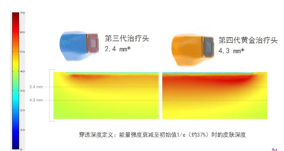 热玛吉抗衰老手术适应6类人群,了解热玛吉抗衰老看这篇就够了