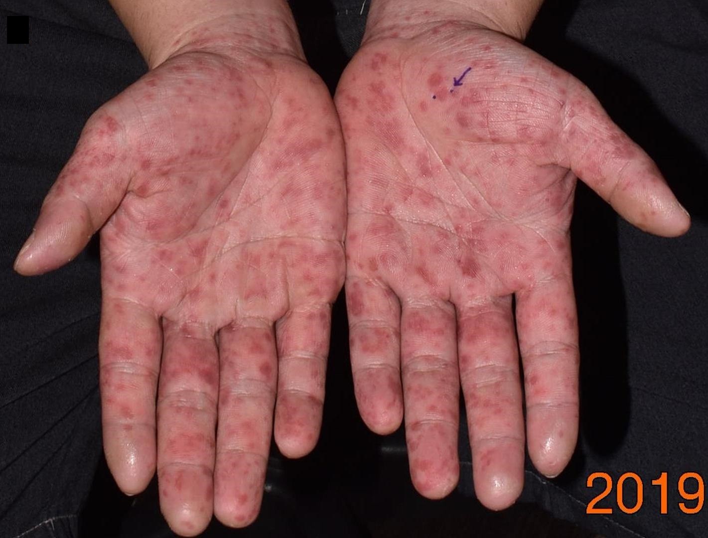 大人感染轮状病毒一直拉肚子,大人得肠病毒