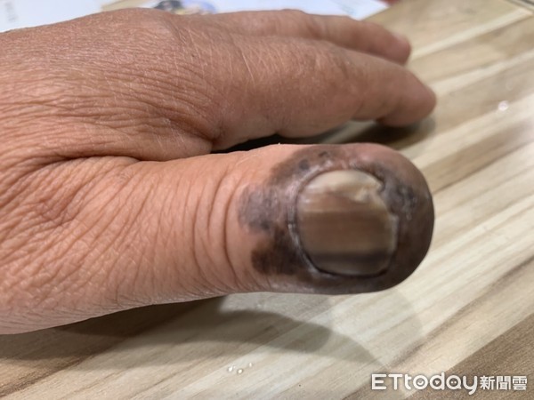 指头发黑坏死是怎么回事,指头紫发黑怎么回事