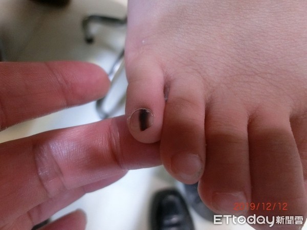 指头发黑坏死是怎么回事,指头紫发黑怎么回事