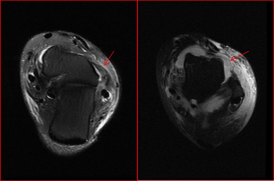 崴脚了医生建议拍片吗,崴脚后核磁可以看到软骨损伤么