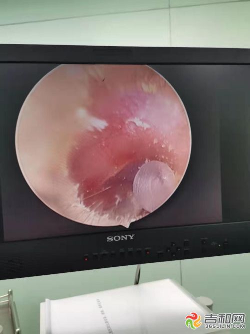 小孩耳朵塞进异物要怎么解决,儿童耳朵塞进了异物视频