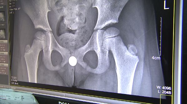 女孩肚子痛还流血,走路都不对劲了