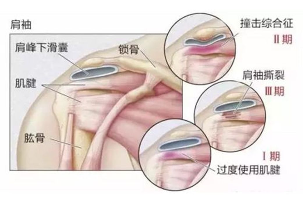 骨科科普|肩峰下撞击综合征