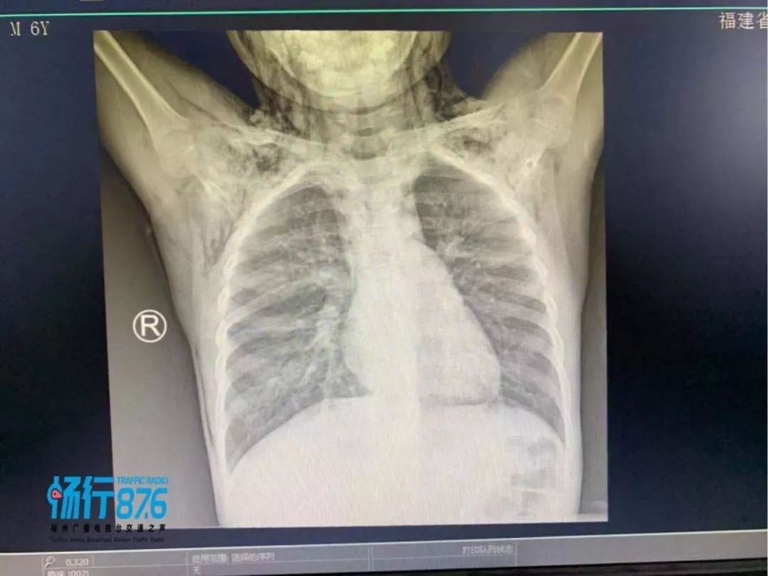 福州一男童上半身充斥气泡，作为家长，值得警醒