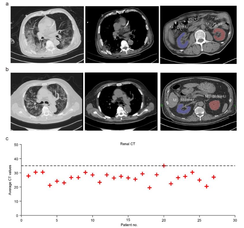最新新冠病毒感染后果,新冠第二次感染死亡是不是谣言